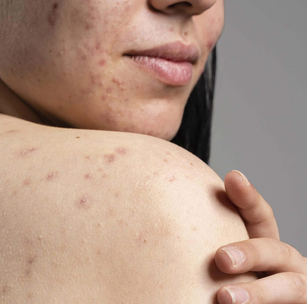 Maison n°7, Institut de beauté à Dinan expert sur les soins cutanés - photo d'un besoin est soins de l'acné